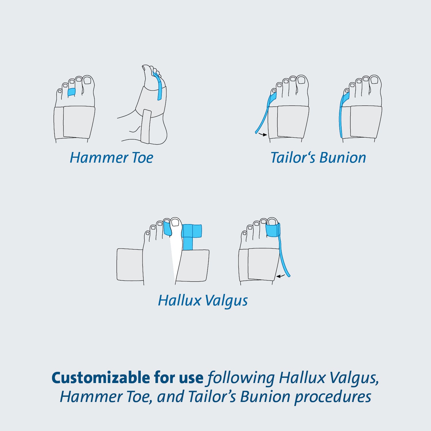 Darco Toe Alignment Splint