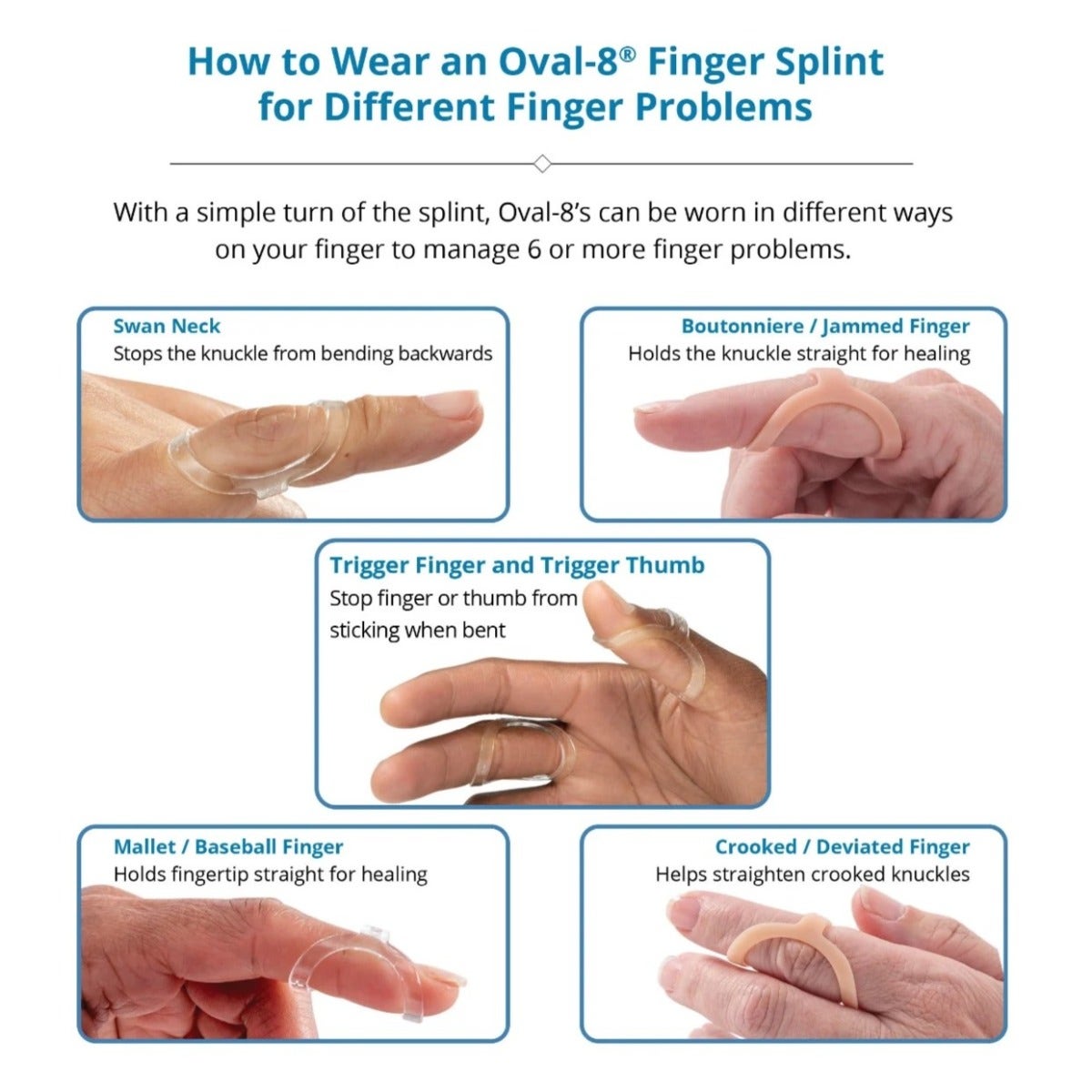 3pp® Oval-8® Finger Splint Kit